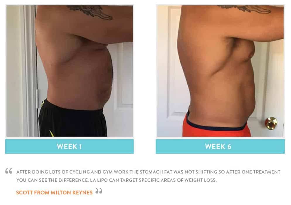 Before & After Stomach Fat West Norwood