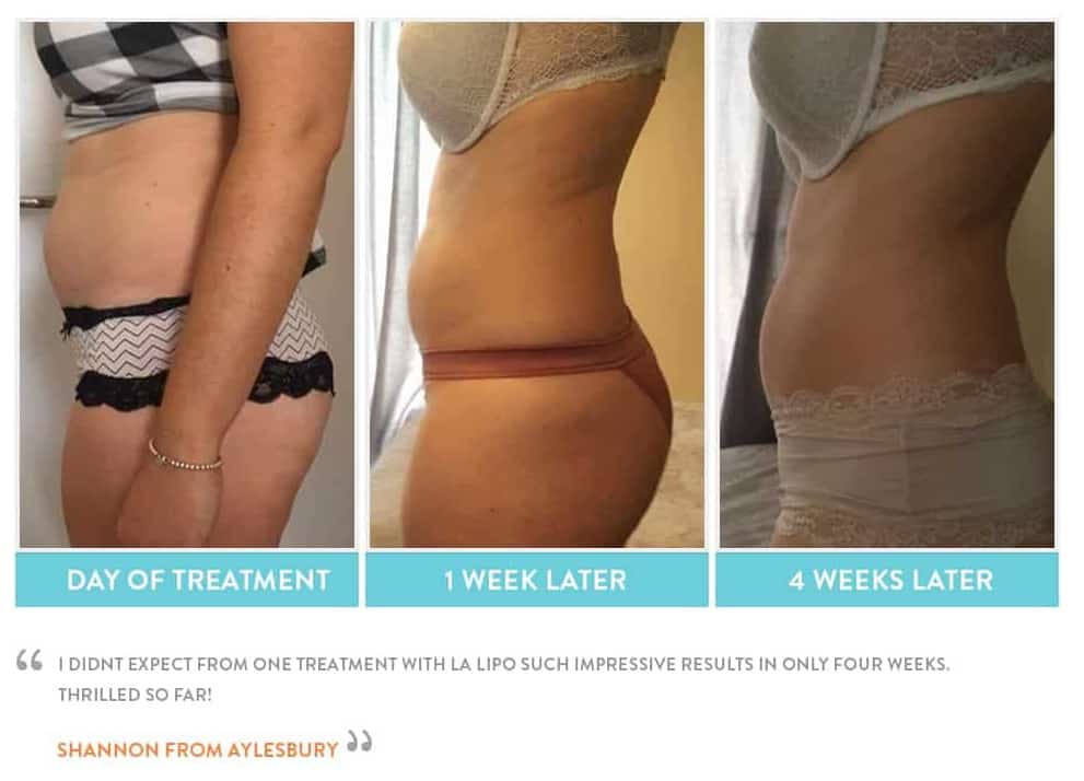 before, Cryolipolysis West Norwood