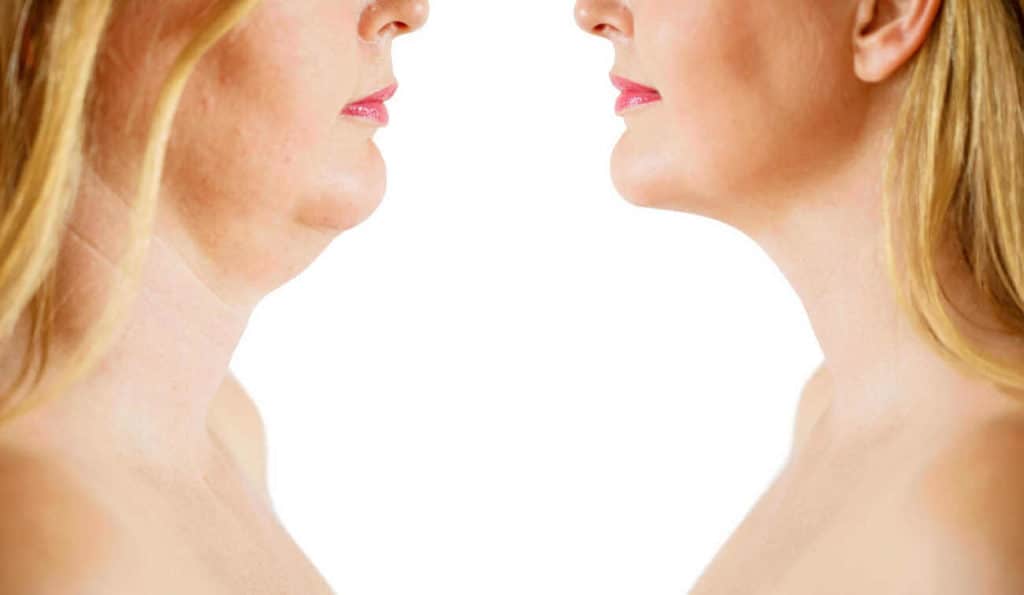 Double Chin treatment West Norwood before and after results
