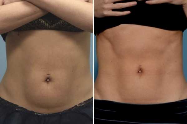 body sculpting FAQs West Norwood
