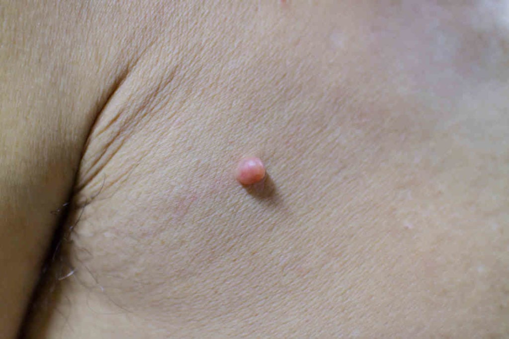 Skin Tag Removal