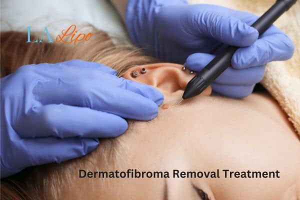 Dermatofibroma Removal Treatment West Norwood