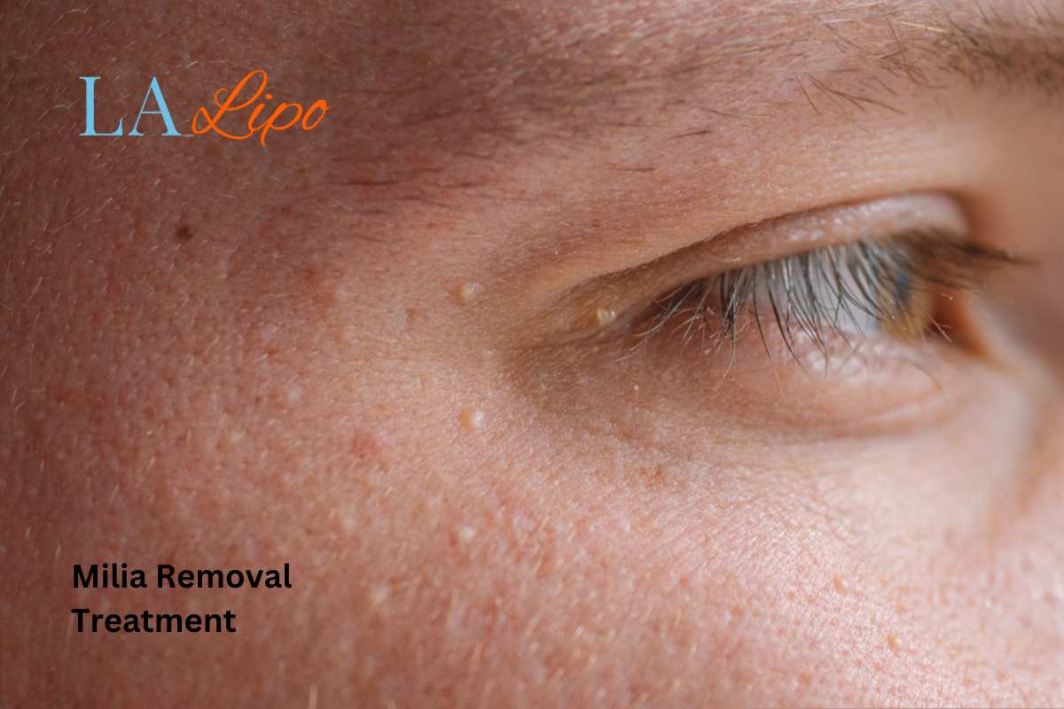 Cryopen Milia Removal: Is It the Easiest and Safest Option West Norwood?