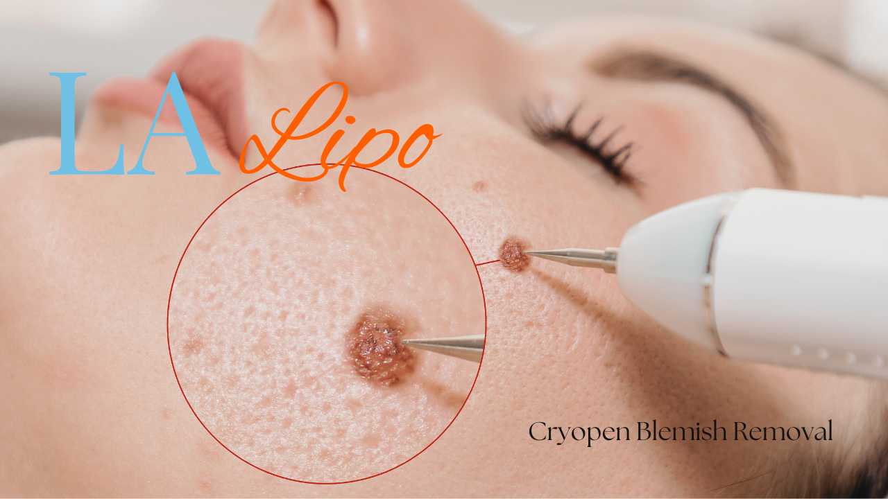 cryopen blemish removal West Norwood Contact our team today!