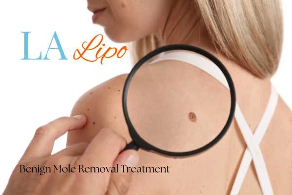 Woman having her inspection of blemish before mole removal West Norwood