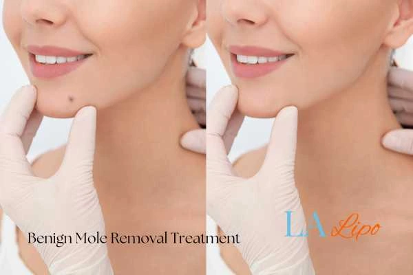 woman's before and after mole removal West Norwood results