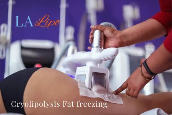 women getting fat freezing West Norwood