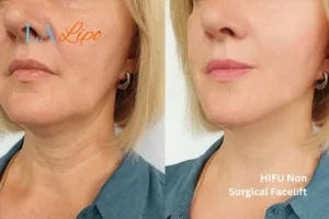 hi-fu for wrinkles West Norwood before and after results