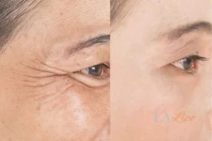 Before and after results of woman - HI-fu wrinkles reduction treatment West Norwood