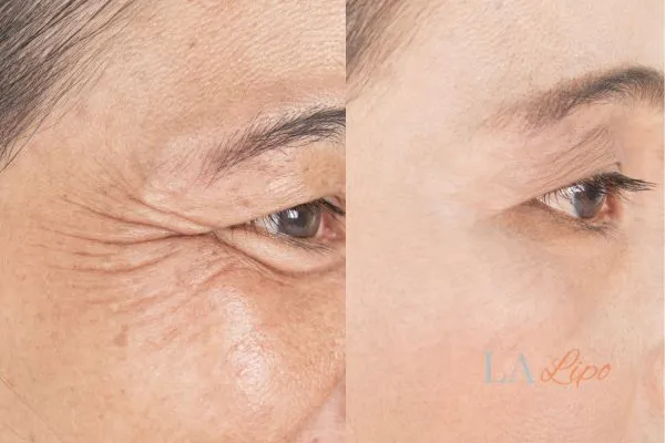 Before and after results of woman - HI-fu wrinkles reduction treatment West Norwood