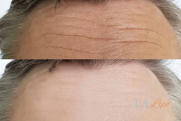 results of HIFU West Norwood on mans forehead to help reduce lines and wrinkles
