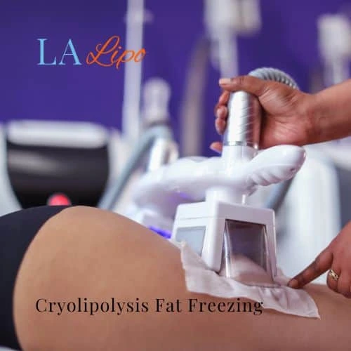 fat freezing - Cryolipolysis West Norwood