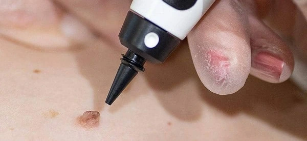skin tag removal using cryopen West Norwood