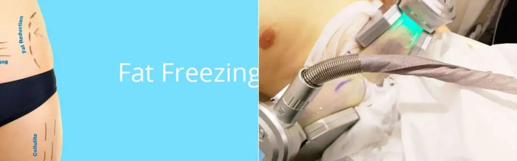multi areas of a persons body having coolsculpting West Norwood treatment