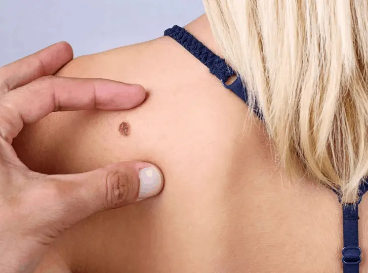 woman having mole removal West Norwood consultation before treatment.