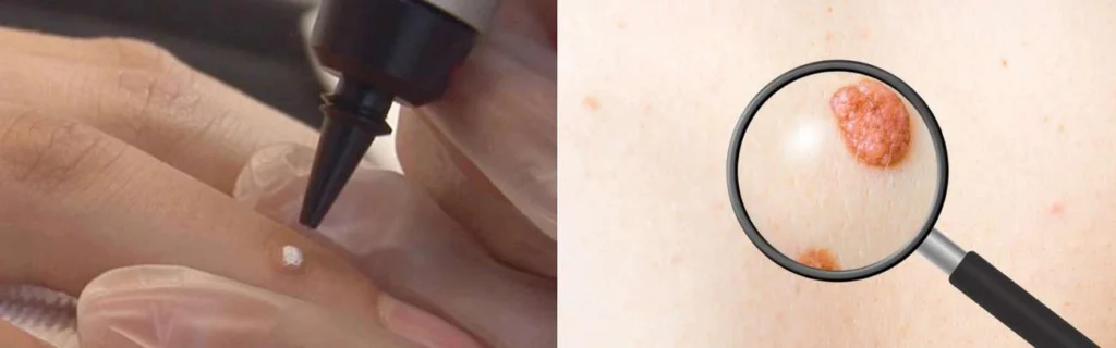 Person getting moles removed with cryopen West Norwood