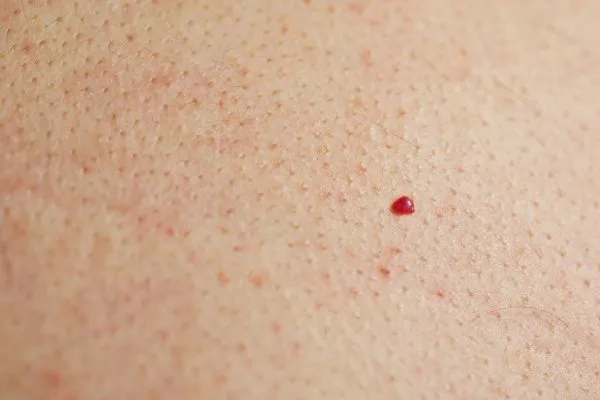close up of a cherry angioma West Norwood