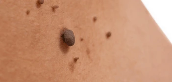 image of a skin tag West Norwood