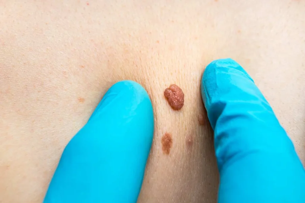 Consultant examining a skin tag West Norwood