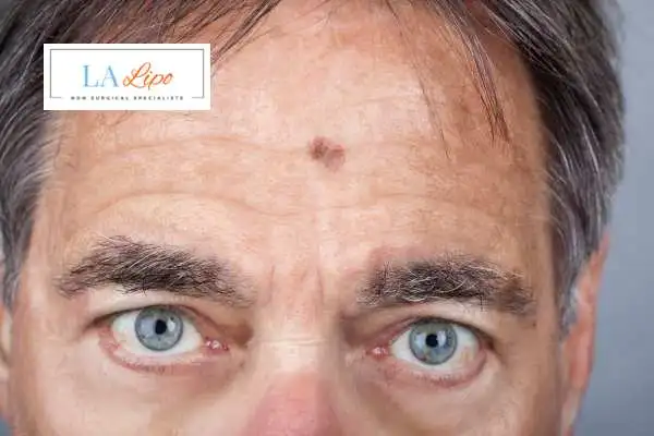 Solar Lentigo Removal West Norwood image of man with mark on his forehead