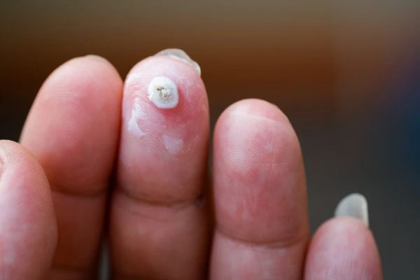 wart on person finger - cryotherapy to treat from LA LIPO West Norwood