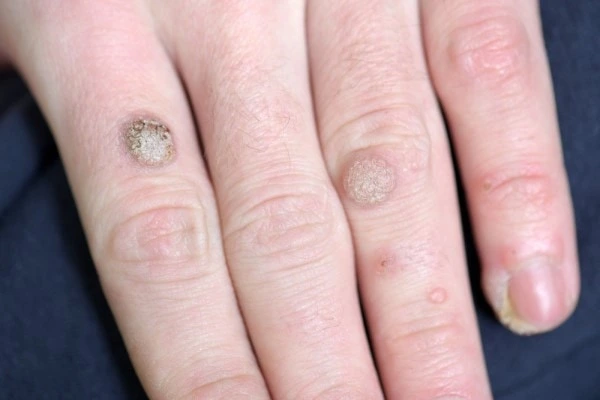 photo of warts on person hand - see wart removal West Norwood from LA LIPO