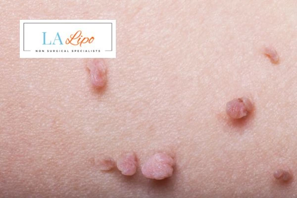 Does cryopen skin tag removal West Norwood hurt? Find out now call our team today!
