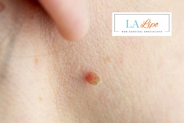 Book skin tag removal West Norwood today speak to our team now!