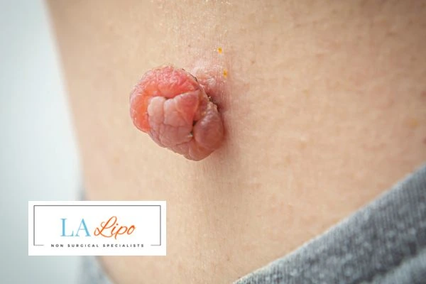 Interested in skin tag removal West Norwood? Concerned about the pain? Find out more today!