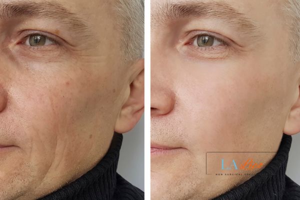 See the amazing results of Morpheus8 Treatment West Norwood!
