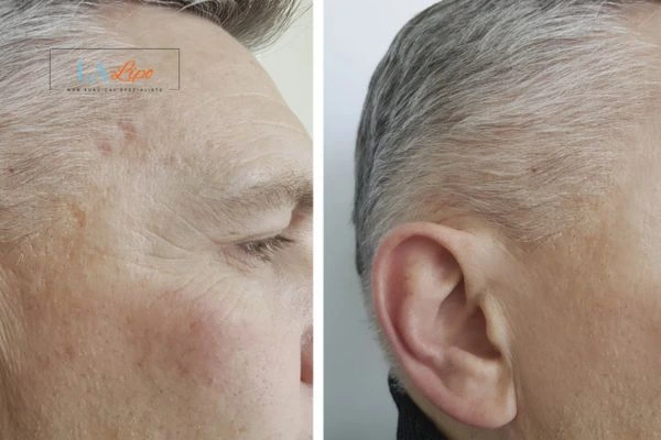 Mens Before & After Morpheus 8 Results West Norwood