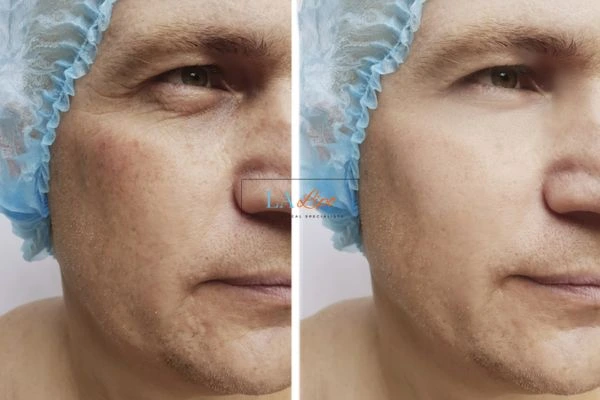 Before and after Morpheus 8 Results West Norwood