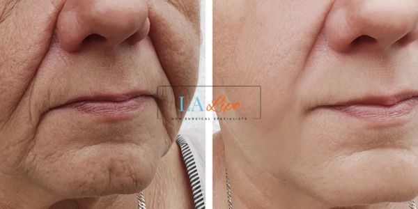 Older lady deeper wrinkle reduction - LA LIPO Morpheus 8 Results West Norwood