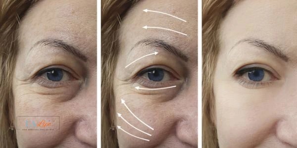 Amazing eye lift Morpheus 8 results West Norwood