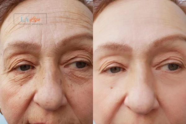 The powerful benefits of Morpheus8 Treatment West Norwood - Call Our team today!