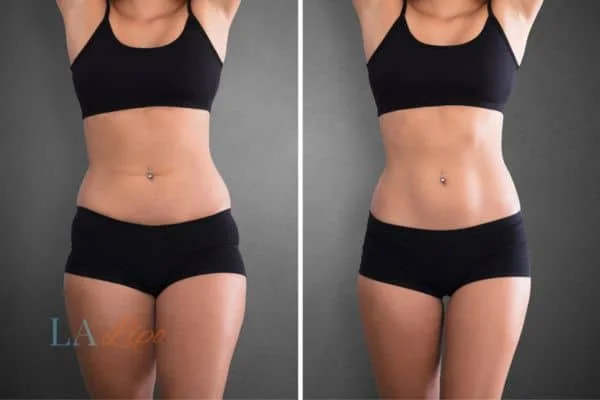 before and after results of non-surgical treatment to help a woman's body image and mental health West Norwood