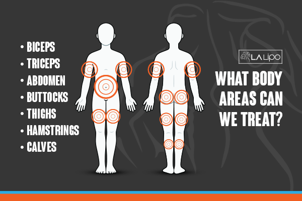 Diagram to show areas you can have LA-EMS Body Sculpting Treatment West Norwood