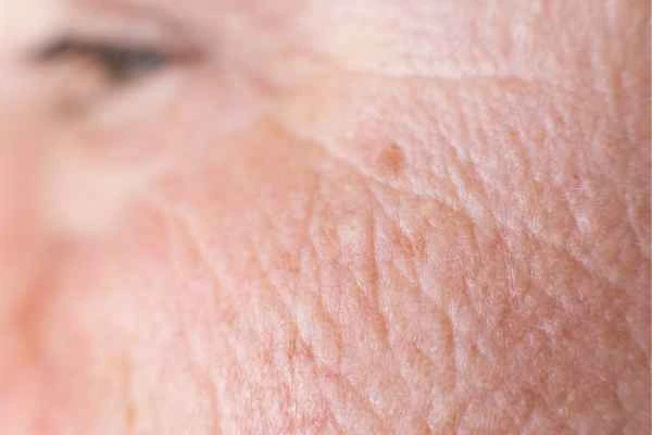 close up picture of a woman's face showing an age spot West Norwood