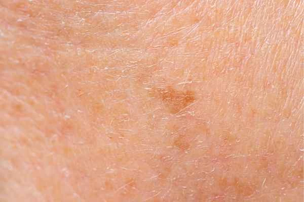 close up picture of age spots West Norwood