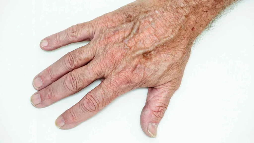Male hand showing age spot West Norwood