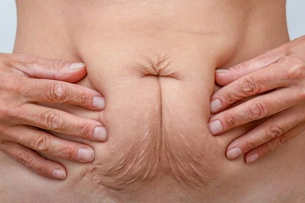 Should I Combine Diastasis Recti Treatment with Body Contouring for Better Results West Norwood?
