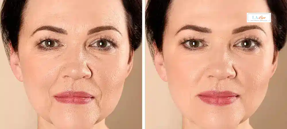How Long Does It Take to See Results and How Long Do They Last West Norwood?