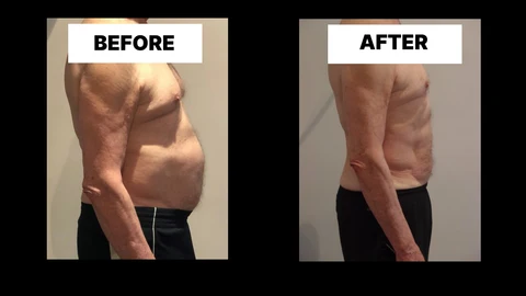 What Symptoms Can Diastasis Recti Cause in Men? Weak Core, Back Pain and Poor Posture West Norwood